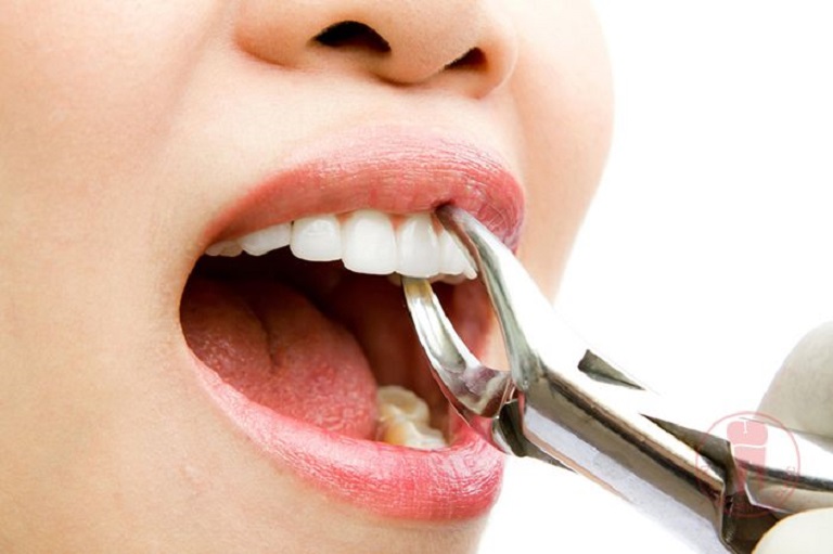 Niềng răng hô phải nhổ răng thường áp dụng với người trên 20 tuổi