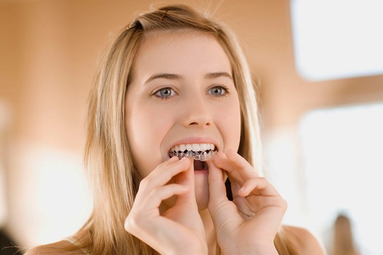 Thời gian bệnh nhân đeo niềng răng sẽ kéo dài từ 1 đến 3 năm tùy vào mức độ hô