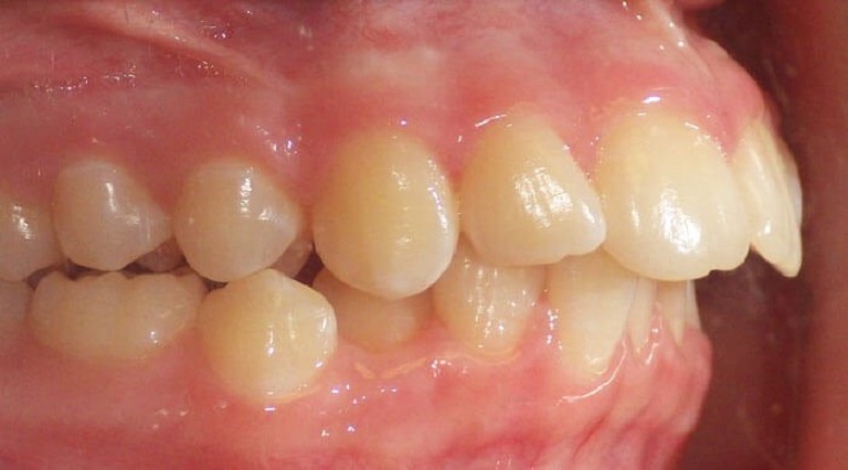 Hô nướu là hiện tượng răng bị hô do xương dưới của nướu nhô ra bên ngoài
