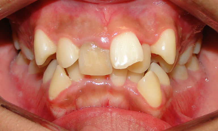 Răng khấp khểnh gây mất thẩm mỹ và ảnh hưởng đến chức năng ăn nhai