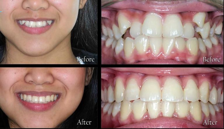 Niềng răng khấp khểnh giúp đưa răng về vị trí ban đầu, cải thiện khả năng ăn nhai