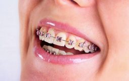Niềng răng khấp khểnh: Lợi ích, quy trình và lưu ý khi thực hiện