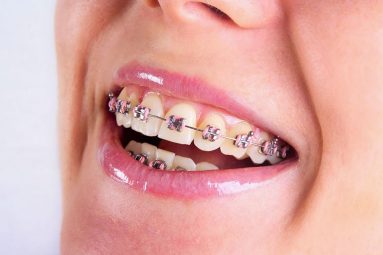 Niềng răng khấp khểnh: Lợi ích, quy trình và lưu ý khi thực hiện