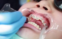 Niềng răng khểnh bao nhiêu tiền phụ thuộc vào phương pháp niềng răng loại nào