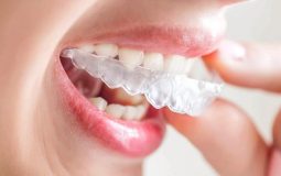 Niềng răng không mắc cài 3D Clear và những thông tin quan trọng