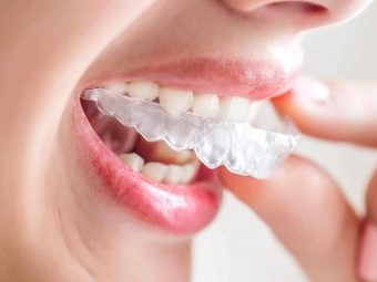 Niềng răng không mắc cài 3D Clear và những thông tin quan trọng