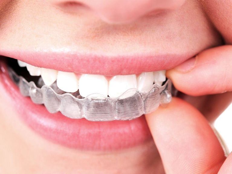 Niềng răng Leetray giá bao nhiêu còn phụ thuộc vào nhiều yếu tố khác nhau
