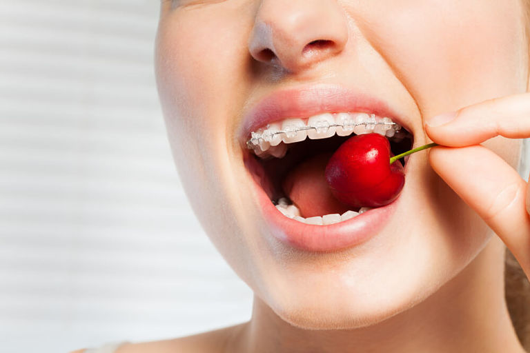 Quá trình ăn uống sau khi niềng răng đóng vai trò rất quan trọng