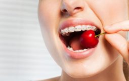 Niềng răng nên ăn gì, kiêng gì là tốt? Một số lưu ý khi thực hiện