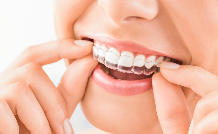 Niềng răng Zenyum là kỹ thuật chỉnh nha hiện đại không sử dụng mắc cài