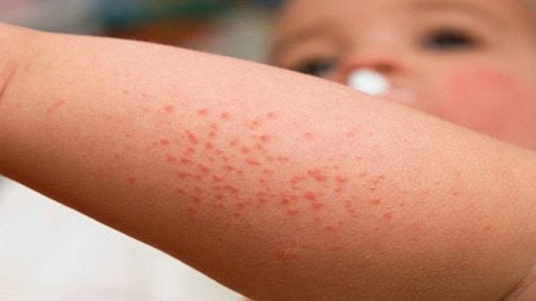 Bệnh ban xuất huyết gây ra những nốt mẩn đỏ trên da