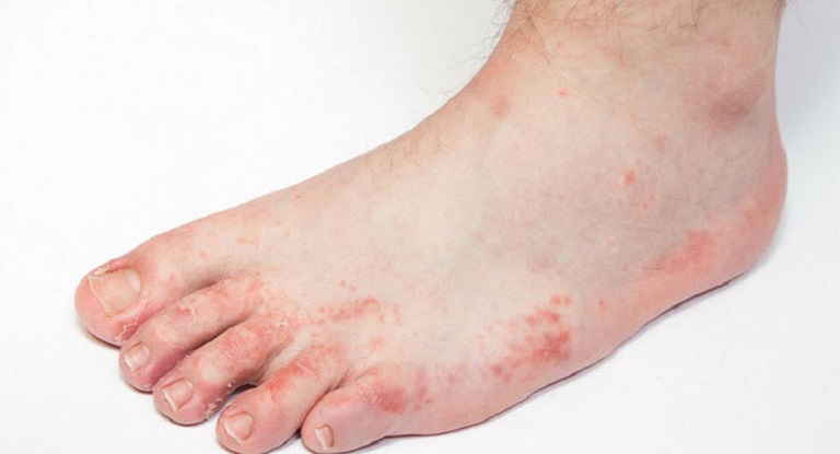 Nổi mẩn ngứa ở chân có thể là triệu chứng của bệnh nấm da