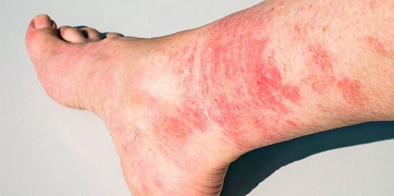 Thường xuyên tiếp xúc với nước bị ô nhiễm có thể gây ra nổi mẩn ngứa ở chân