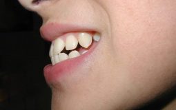 Răng hô nhẹ là tình trạng khớp cắn bị sai lệch.