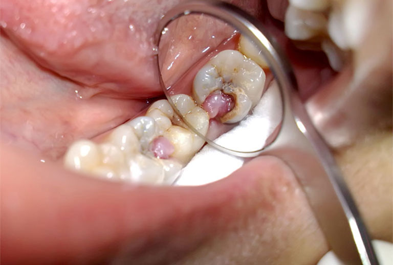 Răng sâu bị lồi thịt là một bệnh lý nha khoa khá nguy hiểm
