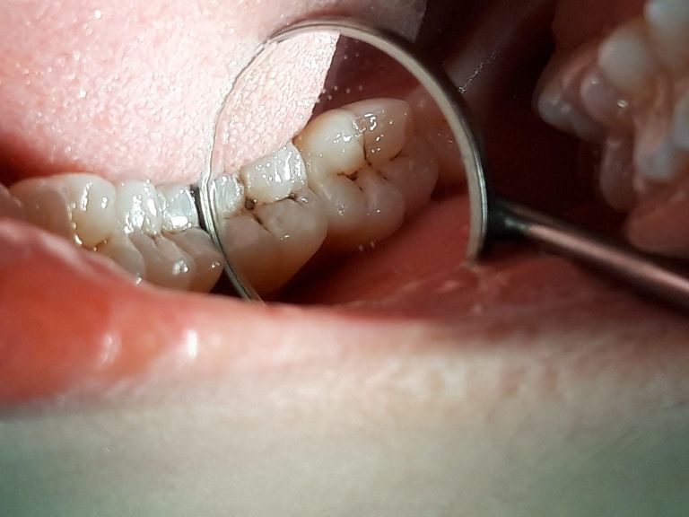 Răng sâu lồi thịt có thể gây biến chứng nhiễm trùng hoặc hoại tử miệng nếu không điều trị sớm