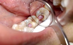 Răng sâu bị lồi thịt: Nguyên nhân, biến chứng và cách điều trị tận gốc