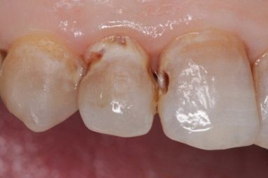 Sâu khe răng là gì? Nguyên nhân, triệu chứng, cách điều trị hiệu quả nhất