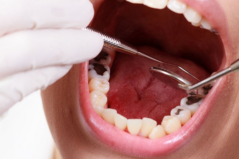 Nhổ răng là phương pháp cuối cùng khi không bảo tồn được răng thật