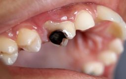 Sâu răng dẫn đến ung thư có hay không? Dấu hiệu nhận biết và cách phòng tránh