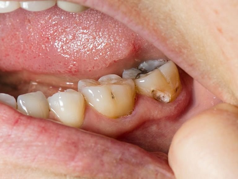 Sâu răng hàm lâu ngày không điều trị có thể gây ra viêm tủy và đau nhức dai dẳng