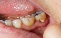 Sâu răng hàm là gì? Nguyên nhân, biểu hiện và cách chữa trị tận gốc