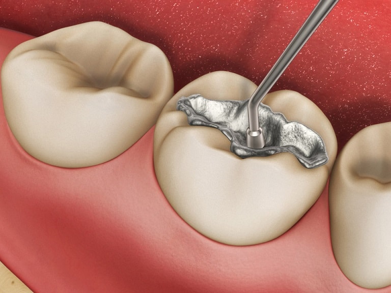 Phương pháp trám răng sâu được nhiều người áp dụng hiện nay