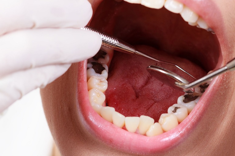 Trám răng sâu lỗ to, khôi phục cấu trúc của răng