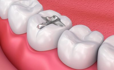 Trám răng sâu là gì? Khi nào thực hiện, các phương pháp, giá bao nhiêu