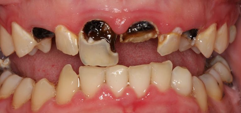 Sâu răng gây ra tình trạng đau nhức răng kéo dài