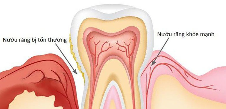 Người niềng răng bị viêm nha chu nặng dễ bị rụng răng