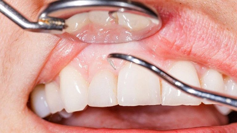 Viêm nha chu khi niềng răng ở mức độ nhẹ có thể điều trị bằng việc cạo cao răng