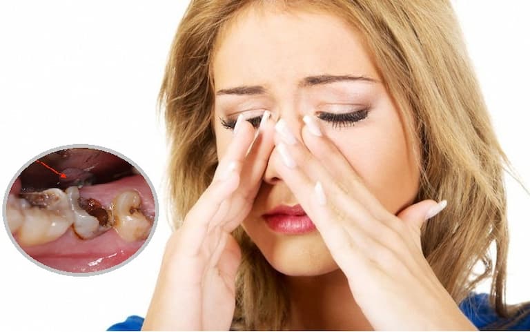 Viêm xoang gây đau răng không phải tình trạng hiếm gặp