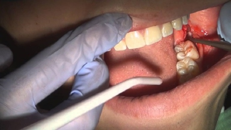 Chức năng của răng hàm của thể hiện ở việc duy trì chiều dài của gương mặt