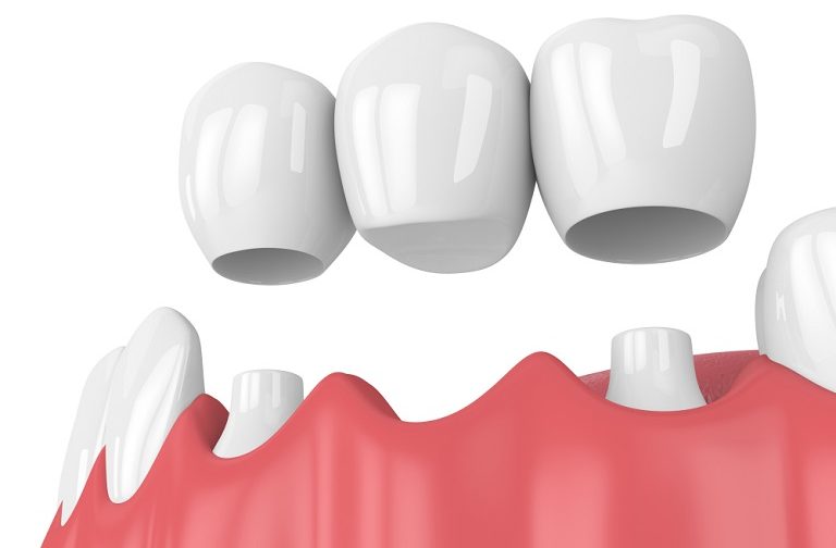 Cầu răng sứ là phương pháp đòi hỏi răng kế cận phải thật sự khỏe mạnh