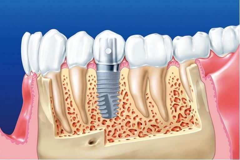 Cấy ghép Implant đang là giải pháp trồng răng hiện đại