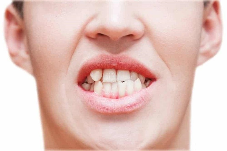Bọc răng sứ chỉ được thực hiện trong trường hợp răng mọc lệch mức độ nhẹ