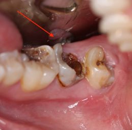 Trường hợp sâu răng phát triển năng, bắt buộc loại bỏ phần tủy răng
