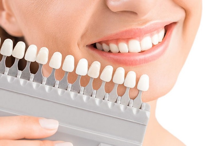 Quy trình bọc sứ răng sứ thường diễn ra khá nhanh chóng, không phức tạp