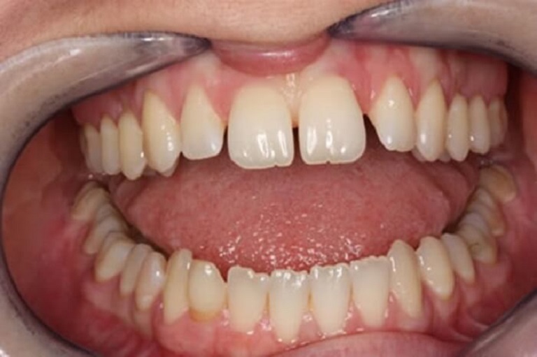 Răng thưa là dạng khiếm khuyết khá phổ biến gây ra những ảnh hưởng về mặt thẩm mỹ