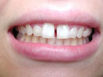 Bọc răng sứ cho răng thưa là phương pháp thẩm mỹ nha khoa quan trọng