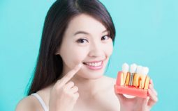 Với trường hợp mất răng toàn hàm, bác sĩ có thể chỉ định thực hiện gắn nhiều trụ răng trên xương hàm
