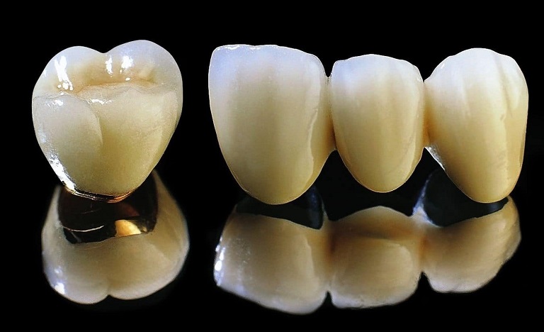 Răng sứ kim loại được thiết kế với phần khung sườn làm từ chất liệu hợp kim