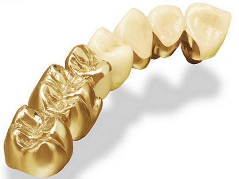 Tuổi thọ của răng sứ kim loại quý thường khá cao trên 15 năm