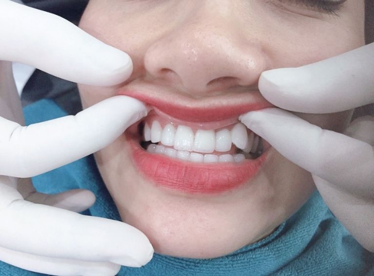 Răng khểnh là loại răng nanh bị mọc lệch so với các răng khác trên cung hàm
