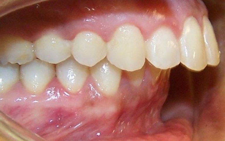 Răng hô nặng được biết tới là một dạng bệnh lý do sai lệch khớp cắn gây ra