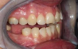 Trồng răng cấm bao nhiêu tiền phụ thuộc vào nhiều yếu tố khác nhau