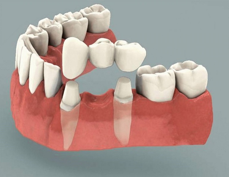 Cầu răng sứ là cách trồng răng giả cố định được áp dụng với người bị mất một hoặc nhiều răng
