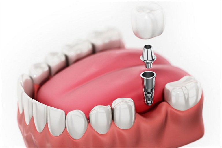 Răng Implant đạt tính thẩm mỹ cao, chất liệu an toàn tuyệt đối cho người dùng