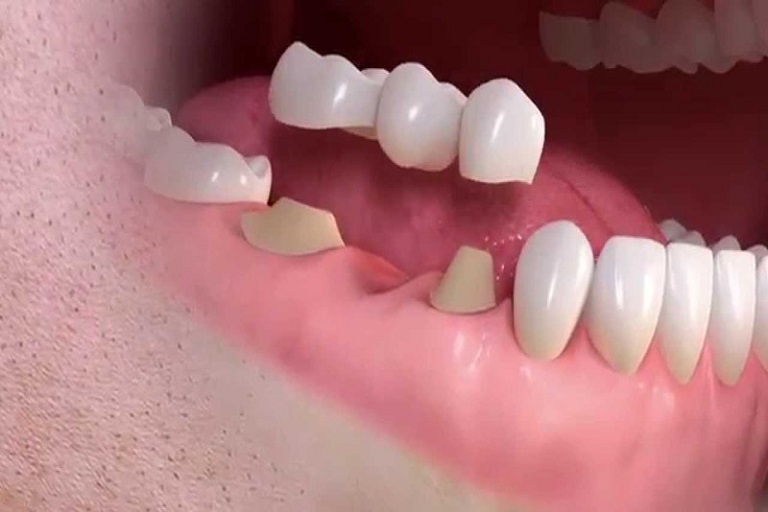 Cầu răng sứ là phương pháp bác sĩ sẽ phải mài 2 răng kế cận để làm trụ răng nâng đỡ